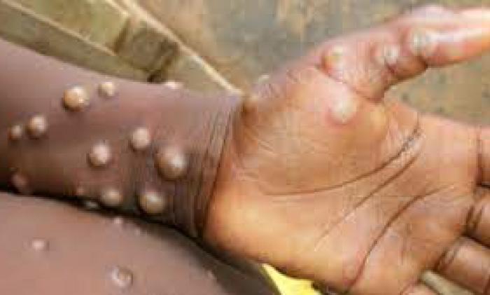 6 cara untuk cegah penularan monkeypox